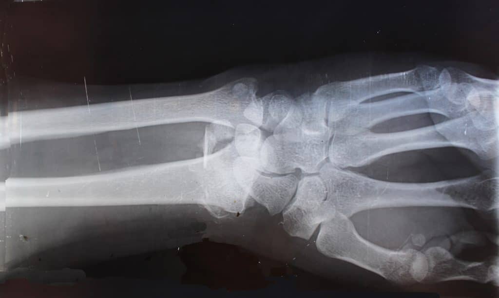 X-ray wrist